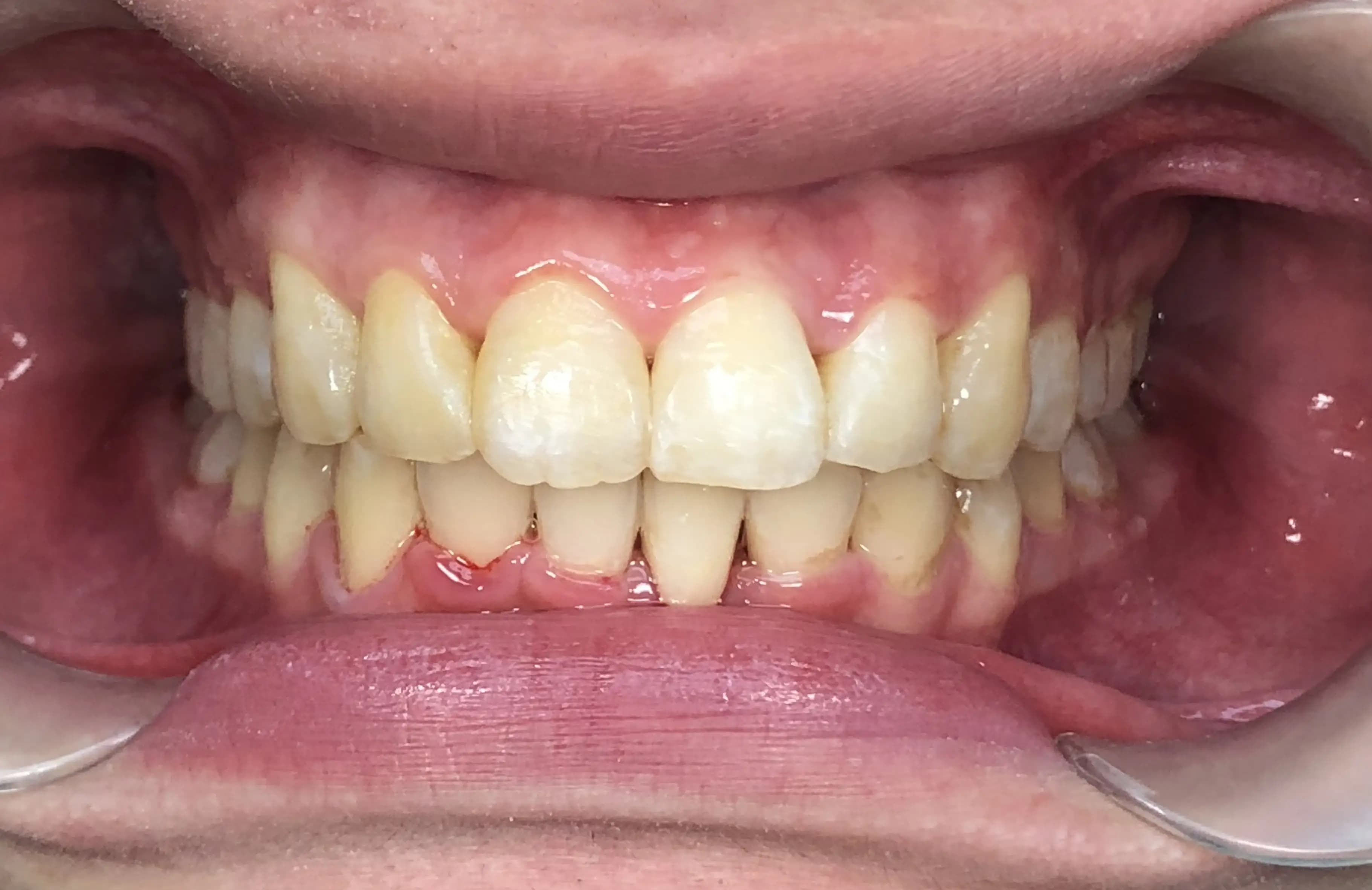 Creating beautiful smile from severely irregular teeth with Damon braces case study