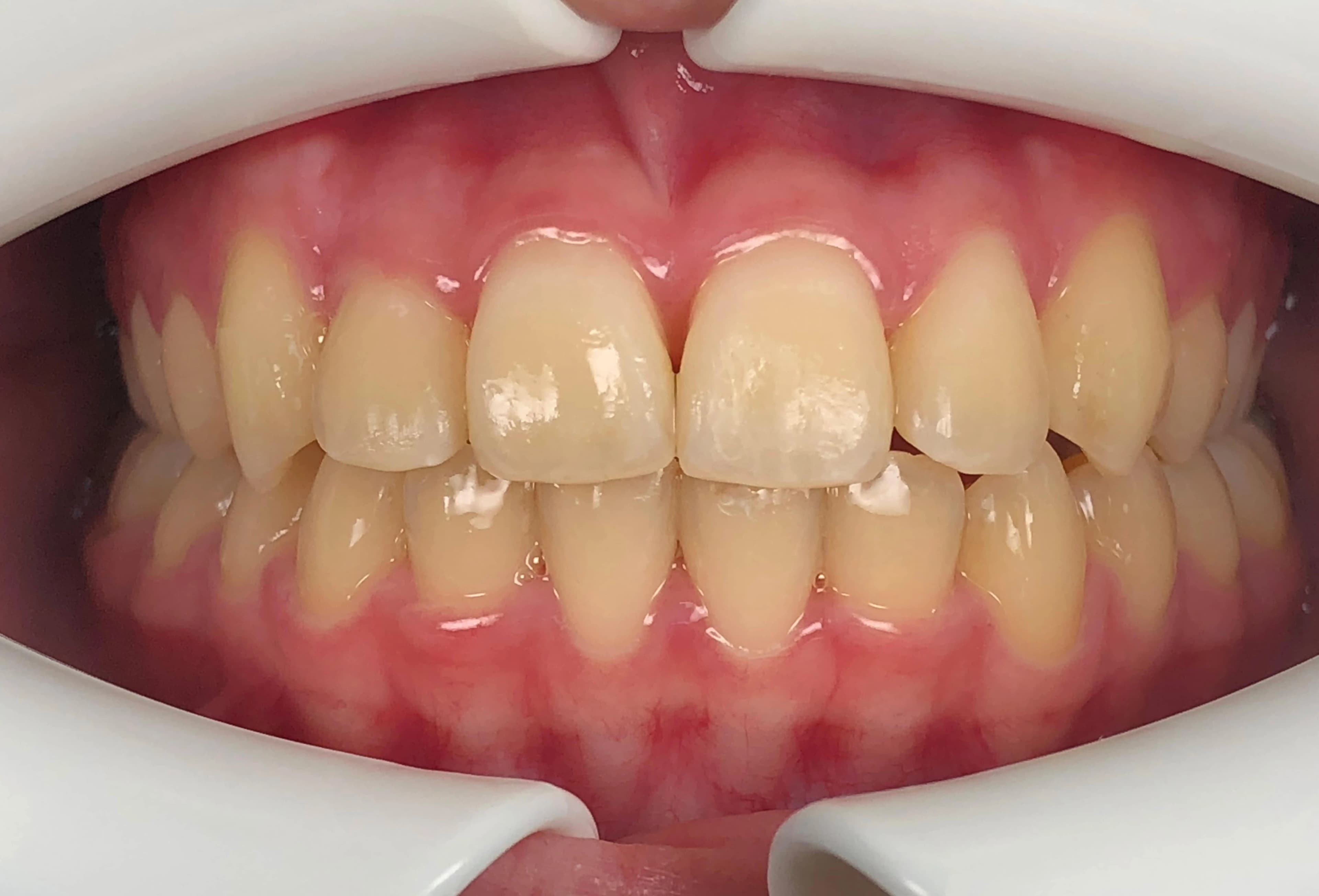 Achieving facial symmetry and bite correction with Damon braces case study