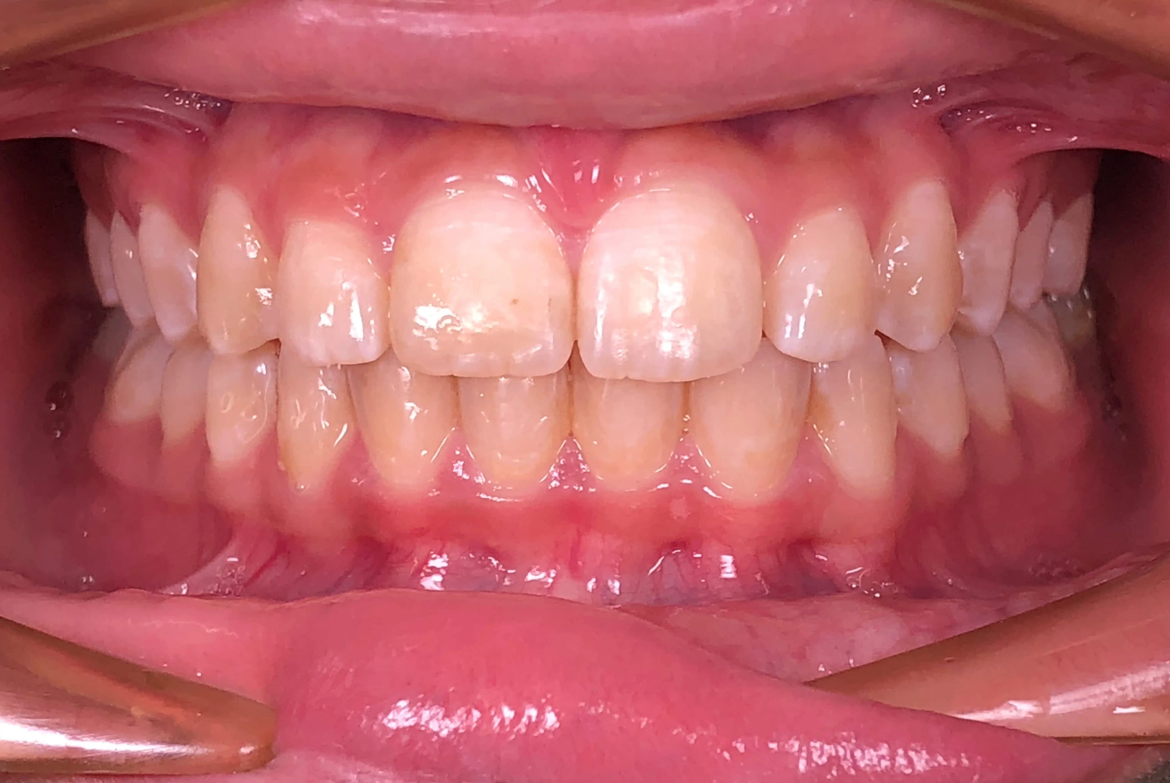 From protrusion to alignment and enhancement dento-facial profile with Invisalign case study