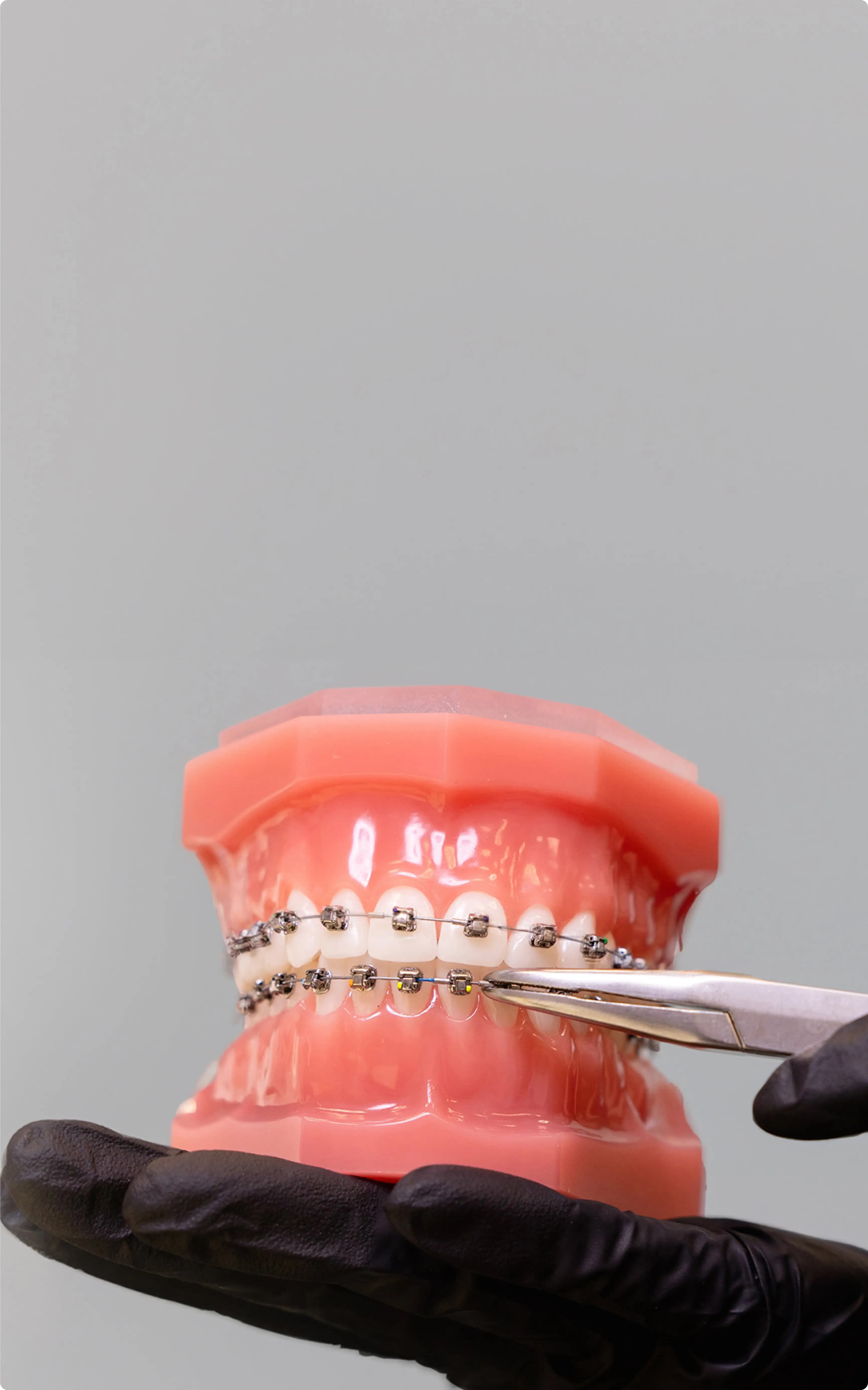 Damon braces example image